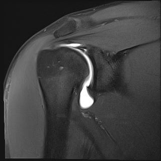 MRI arthrogram