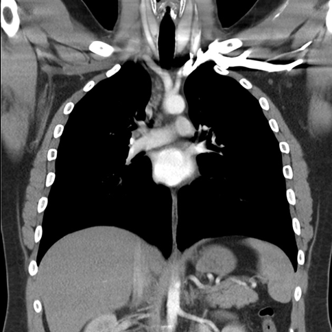 low dose lung cancer screening