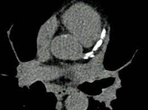 cardiac calcium scoring in utah